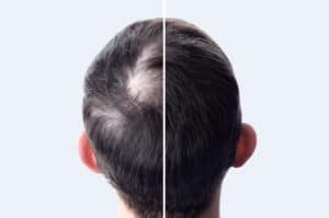 Before and after shots of a mans head after he has received a NeoGraft hair transplant