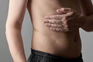 Man's abdomen with long scar running along his waist