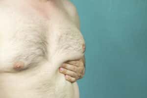 A man's chest with enlarged breasts due to gynecomastia