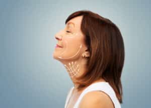 Mature woman with lines illustrated on her face to show facelift possibilities