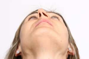 View of woman's crooked nose which could cause breathing issues and be corrected with functional rhinoplasty