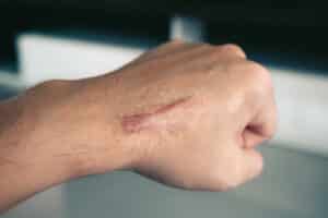 Large scar on back of man's hand that could benefit from laser scar removal