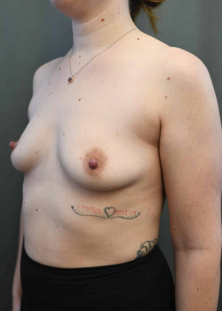 Breast Augmentation