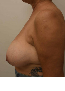 Breast Reduction
