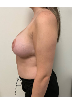 Breast Reduction