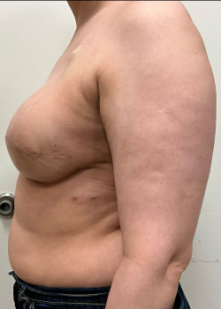 Breast Reconstruction