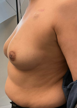 Breast Reconstruction
