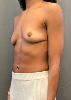 Breast Augmentation