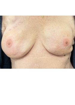 Breast reconstruction