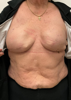 Breast reconstruction
