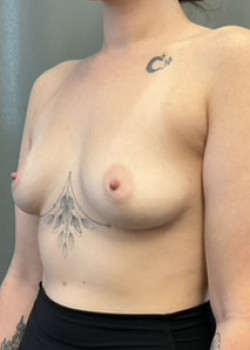 Breast augmentation