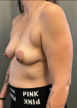 Breast augmentation
