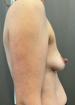 Breast Augmentation W/Pectus Excavatum
