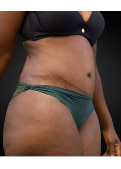 Abdominoplasty