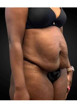 Abdominoplasty